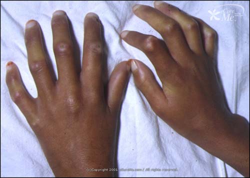 Scleroderma Pictures