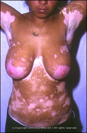 Vitiligo550_ab.jpg